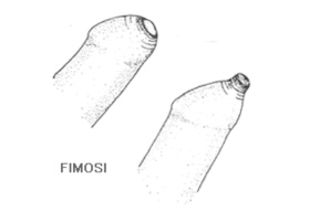 Fimosi Fimosi